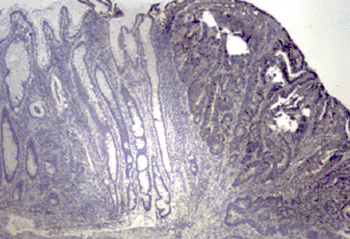 Imagen: Exceso del microARN miR-21 en un tejido tumoral (Fotografía cortesía del Centro para la Investigación del Cáncer).